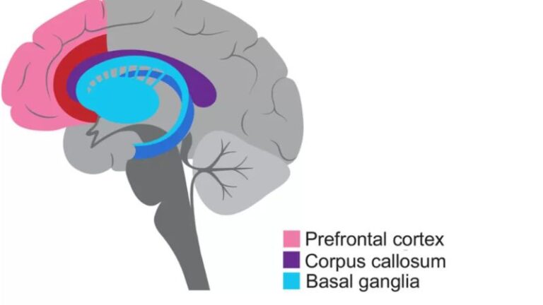Brain diagram showing regions affected by ADHD for neuropsychological insight