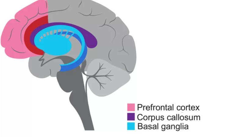 Brain diagram showing regions affected by ADHD for neuropsychological insight